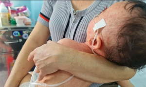 Dịch sởi có xu hướng giảm