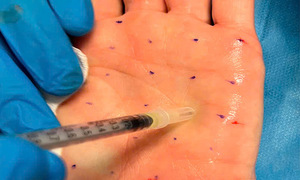 Tiêm botox giảm mồ hôi tay