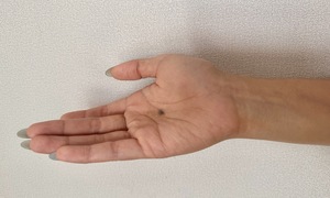 Những vị trí khó ngờ có thể bị ung thư da