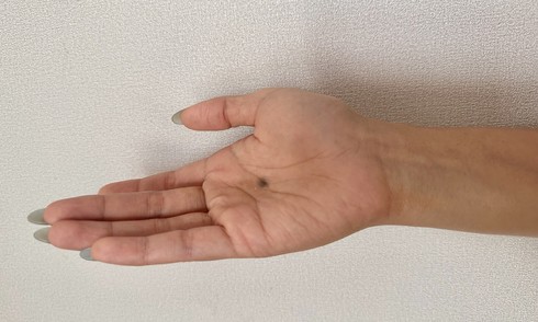 Những vị trí khó ngờ có thể bị ung thư da