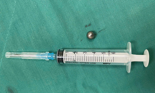 Bé trai 5 tuổi nhập viện cấp cứu vì đạn bi súng đồ chơi