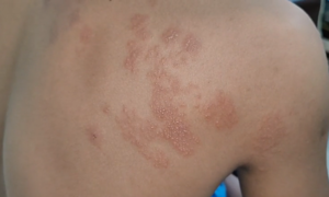 Zona thần kinh gây đau như thế nào?
