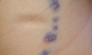 Nốt thủy đậu đóng vảy có lây bệnh?