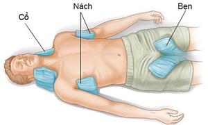 Nguy cơ rối loạn thần kinh, suy đa tạng bởi say nắng
