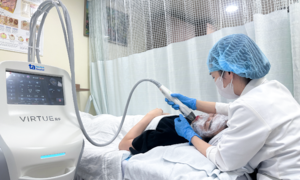Có nên trị sẹo mụn bằng vi kim?