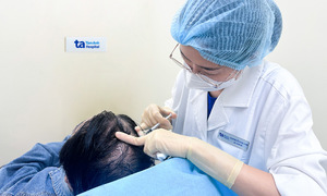 Tiêm meso chữa rụng tóc