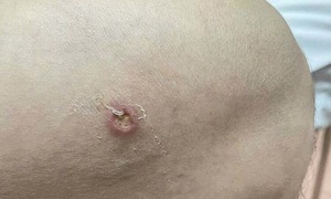 Phát hiện ca bệnh giun rồng thứ 26