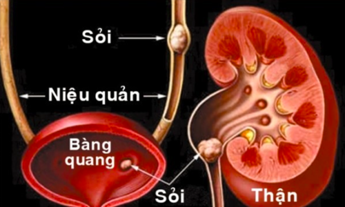 'Sỏi im lặng' âm thầm gây biến chứng nặng