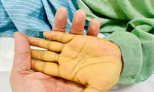 Nguy kịch vì hàng tỷ bản sao virus viêm gan B trong máu