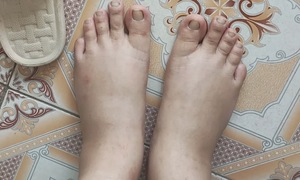 Dấu hiệu tổn thương thận do tăng huyết áp