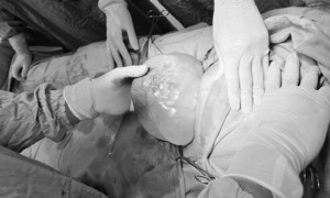Sinh đôi, một bé còn trong bọc ối
