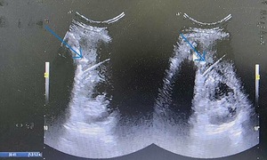 Sốt nhiều tháng, bất ngờ phát hiện tăm xỉa răng đâm trong bụng