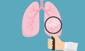 4 lý do ung thư phổi ở người không hút thuốc gia tăng