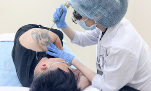 Xóa xăm bằng laser pico