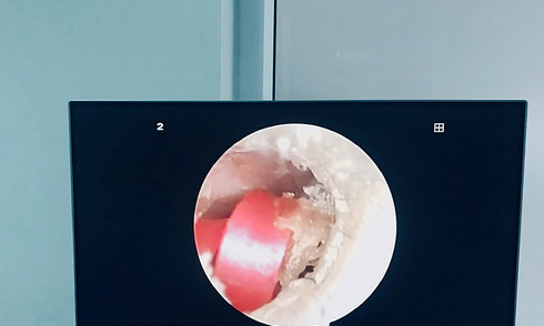 Sợi dây buộc tóc suýt gây thủng màng nhĩ bé gái