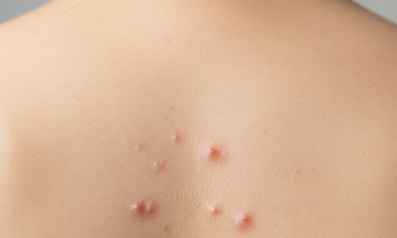Cách giảm mụn lưng