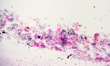 Hai loại virus làm tăng nguy cơ ung thư khoang miệng