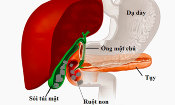 Sỏi mật - quả bom nổ chậm