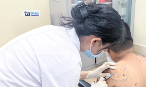 Sẹo lồi do biến chứng mụn
