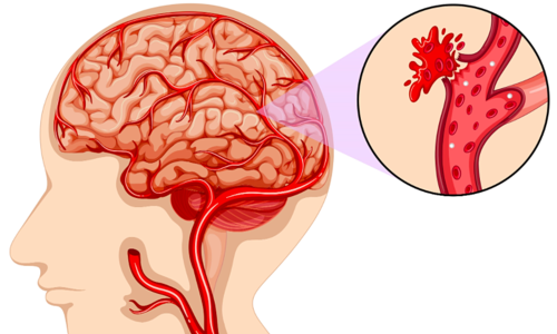 Huyết khối tĩnh mạch não khác đột quỵ thế nào
