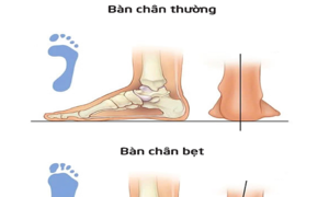 Cách nhận biết sớm bàn chân bẹt ở trẻ
