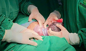 Bé gái chào đời với dây rốn quấn 4 vòng cổ