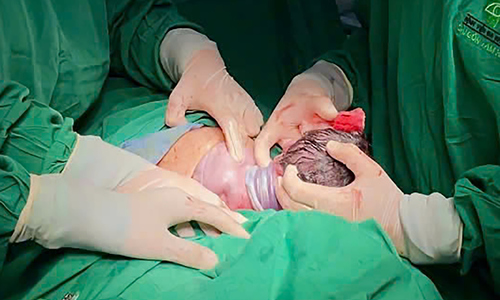 Bé gái chào đời với dây rốn quấn 4 vòng cổ