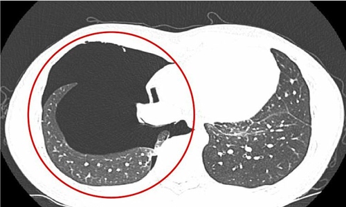 Đẩy tạ quá sức, nam thanh niên tràn khí màng phổi