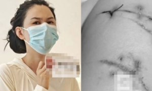 Thoát chết nhờ túi độn ngực
