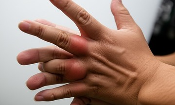 6 triệu chứng tăng axit uric xuất hiện ở tay, chân