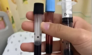 Máu bé gái màu nâu đen do ngộ độc methemoglobin sau bữa ăn
