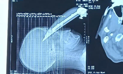 Cứu sống bệnh nhân bị lưỡi dao máy cắt cắm xuyên sọ não