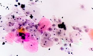 Dấu hiệu nào cảnh báo mắc bệnh liên quan đến HPV?