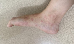 Các bệnh da liễu thường gặp ở trẻ vào mùa hè