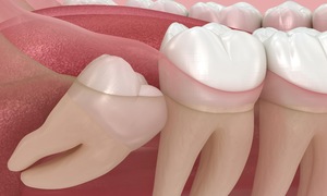 Vì sao một số người không mọc răng khôn?
