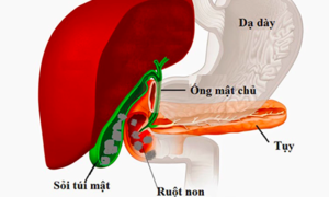 Nguy cơ ung thư đường mật từ những viên sỏi nhỏ