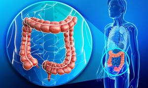 Tưởng đau bụng thông thường hóa ung thư đại tràng giai đoạn 3