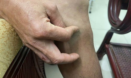 70cm guinea worm removed from man's leg