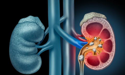Four tips to prevent kidney stones