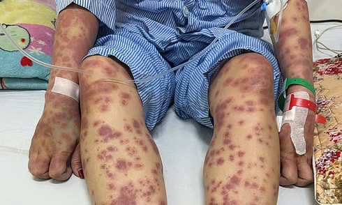 Dị ứng nặng sau uống viên giảm cân thải độc