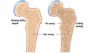 Loãng xương và cách phòng ngừa
