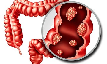 Bỏ qua triệu chứng quen thuộc, người phụ nữ phát hiện ung thư khi đã di căn