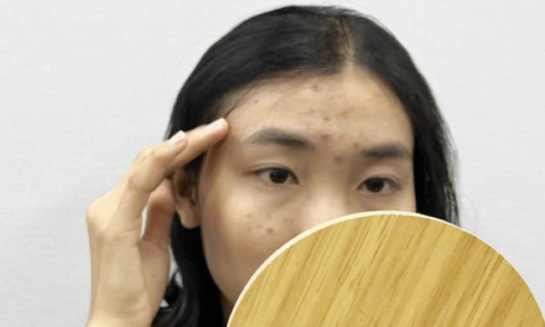 Understanding and managing hormonal acne