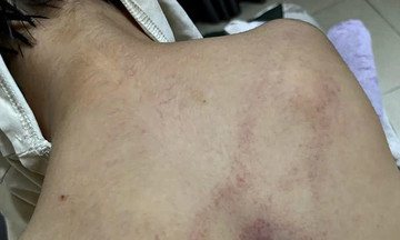 Bé 4 tuổi bị đánh tím lưng ở lớp