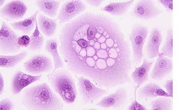 Điều trị ung thư da bằng virus Herpes