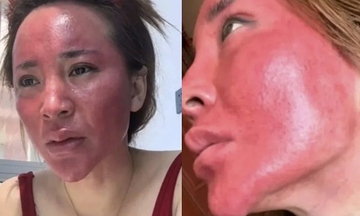 Không tẩy trang suốt 22 năm, người phụ nữ gặp biến chứng da nghiêm trọng