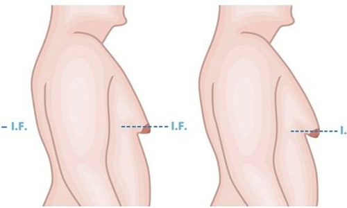 Vì sao nam giới có hiện tượng ngực to như phụ nữ?