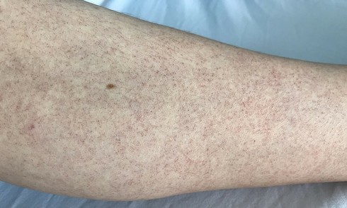 The lingering impact of severe dengue fever