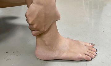 Các biến chứng bệnh gout