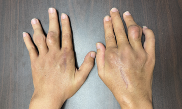 Sống chung bệnh gout từ tuổi đôi mươi